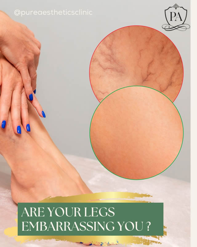 Microsclerotherapy